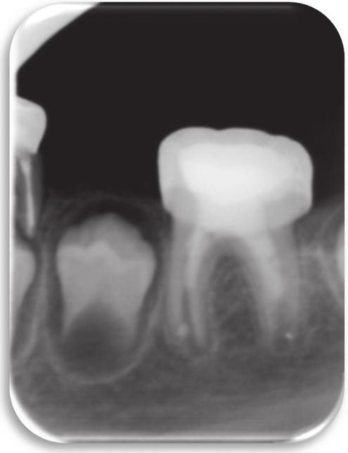 Apical closure has not yet takenplace,althoughitisexpectedtohaveoccurredbythe next check-up (Figure 3) 2.4. Case 4. An eight-year-old patient went to the pediatric dental clinic with multiple caries.