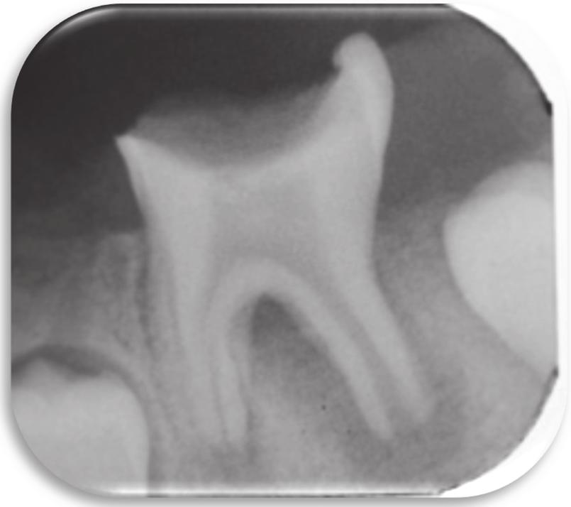 Case Reports in Dentistry 5 Figure 4: Periapical radiograph taken at the first visit, showing large occlusal caries on tooth 36 with pulp exposure, open apices, and a radiotranslucency encompassing