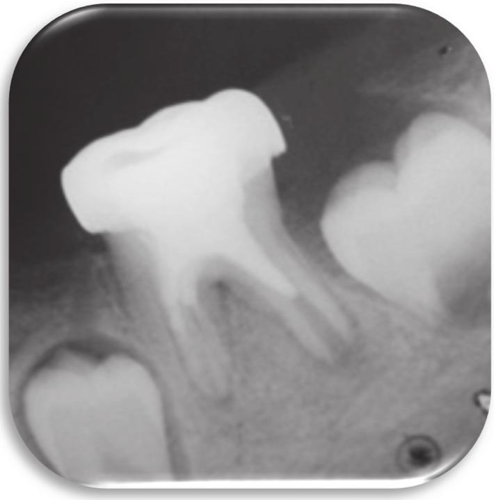 periapical status of the tooth. After local anesthesia, the tooth is isolated with a rubber dam and the crown cleaned with 2% chlorhexidine.