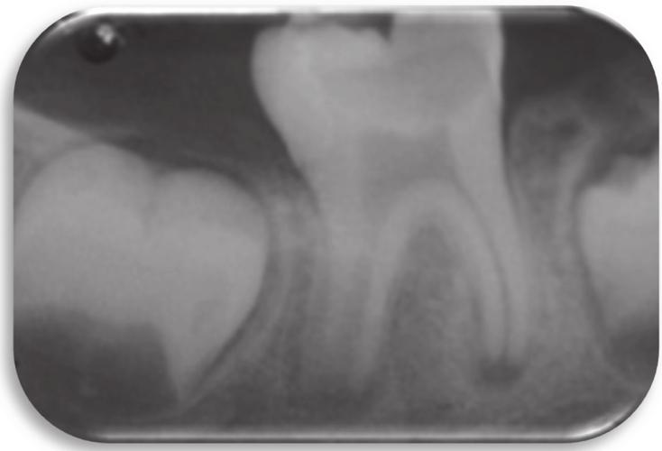 6 Case Reports in Dentistry Figure 5: First visit showing occlusal caries on tooth 46 extending to the pulp chamber, with open apices. Determination of working length.