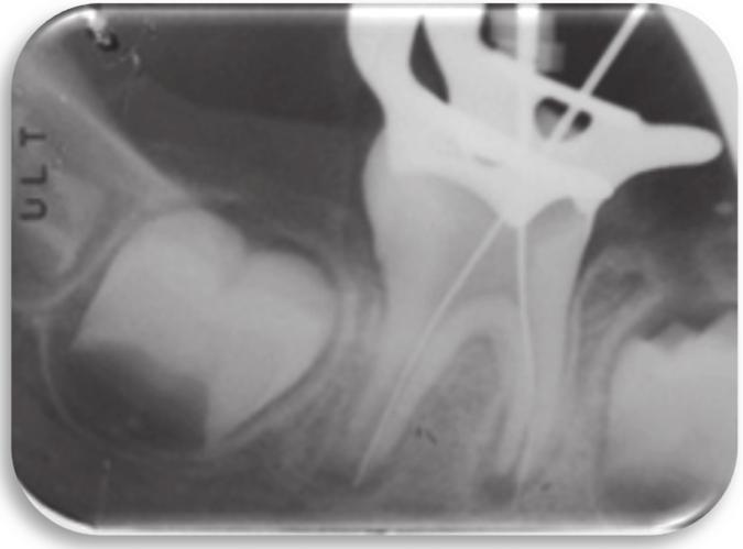 A complication associated with revascularization is obliteration of the root canals that is shown here. revascularization [3, 5, 8, 11, 13 15].