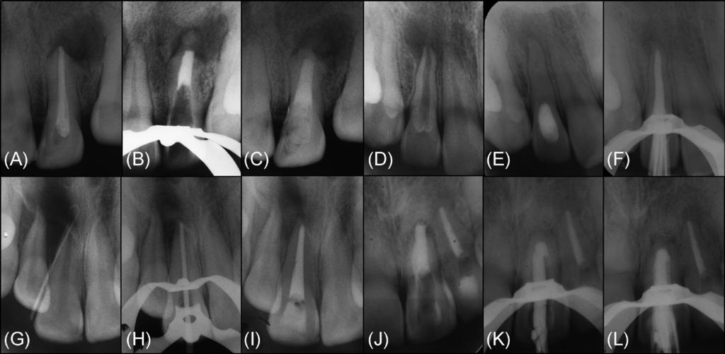 Fig. 2: Radiographic sequence of the diverse endodontic techniques performed in permanent teeth with necrotic pulp and open apices included in this study.