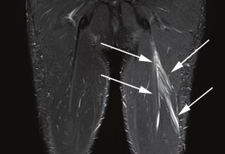 2 3 4 Figure 2: Coronal STIR MRI of the thigh in a professional athlete. There is a grade I injury of the proximal long head of biceps muscle (arrow).