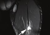 Figure 4: Sagittal T2-weighted MRI of the upper thigh in an amateur athlete. There is a full-thickness avulsion of the common hamstring attachment from the ischial tuberosity.