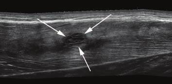 SPORTS RADIOLOGY 5 6 Figure 5: Extended field-of-view ultrasound scan of the thigh in a professional footballer.