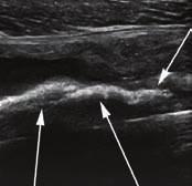 Intermuscular and perifascial fluid collections are common in grade II injuries.