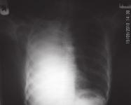 Fig. 1: Chest X-ray showing destruction of the right lung with ipsilateral shift of the mediastinum and compensatory emphysema in the left lung of a patient with unilateral tuberculous destruction of