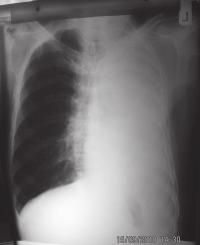 2: Chest X-ray showing destruction of the left lung with ipsilateral shift of the mediastinum and compensatory emphysema in the right lung of a patient with unilateral tuberculous destruction of the