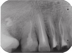 Mandibular Incisors with Two Canals Y. S. Kabak and P. V.