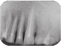 The patient had not experienced any symptoms and was seeking endodontic treatment of the mandibular incisors before having metal-ceramic crowns placed to restore these teeth as they had marked
