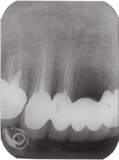Non-surgical endodontic treatment was planned with exploration, cleaning, shaping and filling of the root canal systems of two teeth per appointment while anaesthetised with an infiltration injection