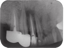 Mandibular Incisors with Two Canals Y. S. Kabak and P. V. Abbott (a) (b) (c) (d) Figure 2 Case report 2. (a) Preoperative periapical radiograph of the mandibular right lateral incisor.