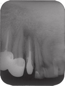 (b) Postoperative periapical radiograph following endodontic treatment of the mandibular right lateral incisor.