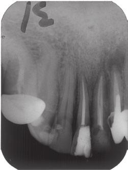(d) Postoperative radiograph after endodontic treatment of the mandibular right and left central incisors. This radiograph was taken 14 months after the radiograph in Figure 2c.