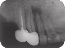 presented cases, there were no signs of the second root canals on the panoramic radiograph and the periapical radiographs taken with standard ( straight on ) angles were not sufficient to detect the