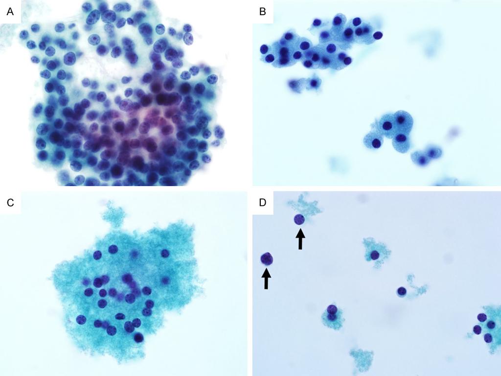 Figure 3. Cytologic features of parathyroid fine needle aspiration specimens prepared using ThinPrep. A. A threedimensional cluster of parathyroid cells with a microfollicular arrangement.