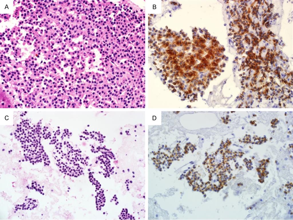 Figure 6. Cell blocks of parathyroid fine needle aspiration specimens. (A) Parathyroid lesions with predominant oxyphilic cells and (B) positive immunostaining for parathyroid hormone.