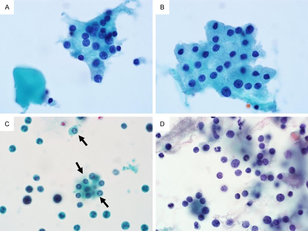Figure 7. Cytologic features of liquid-based cytology specimens for the differential diagnoses of parathyroid and thyroid lesions. A.