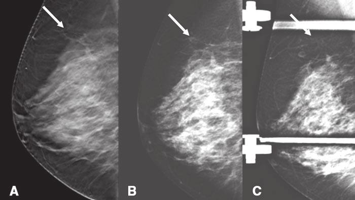 Digital Breast Tomosynthesis cific purpose and optimized to enable viewing a specific suspected region within the breast (e.g., spot compression) is not an easy task, despite anecdotal and personal perception that DBT should be better for diagnostic purposes.