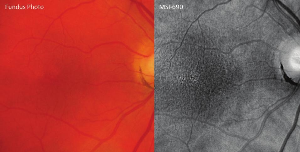 Figure 3. Mild retinal pigment epithelium disruptions, including melanin pigment changes, are seen on the MSI-690 image of a 49-year-old male on the right.