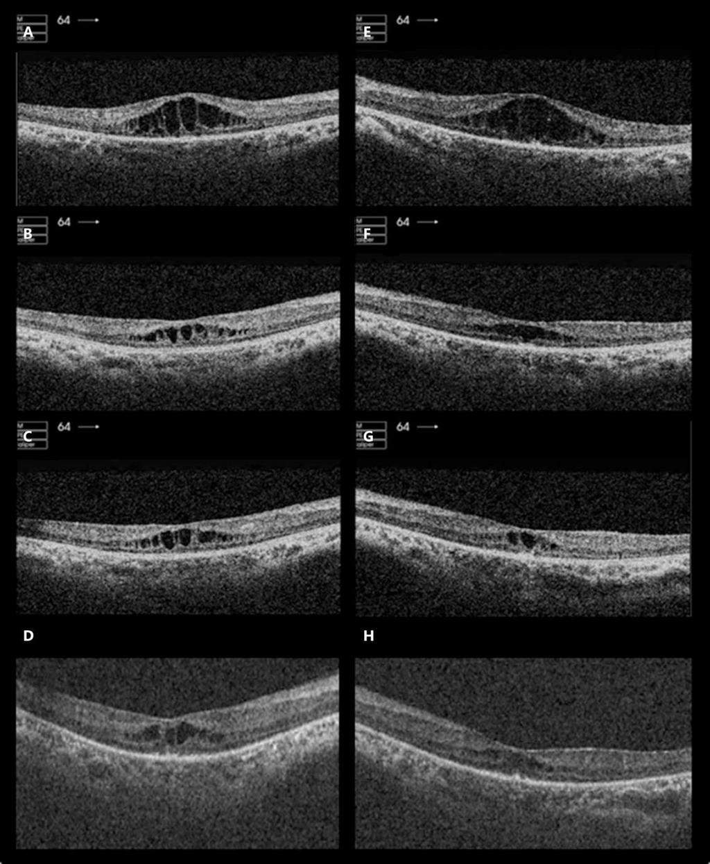 394 Fig. 1. OCT of both eyes before and after intravitreal injections of aflibercept given in the UK.