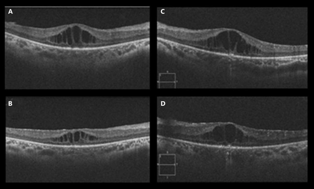 395 Fig. 2. OCT of both eyes before and after intravitreal injections of ranibizumab given in Dubai.