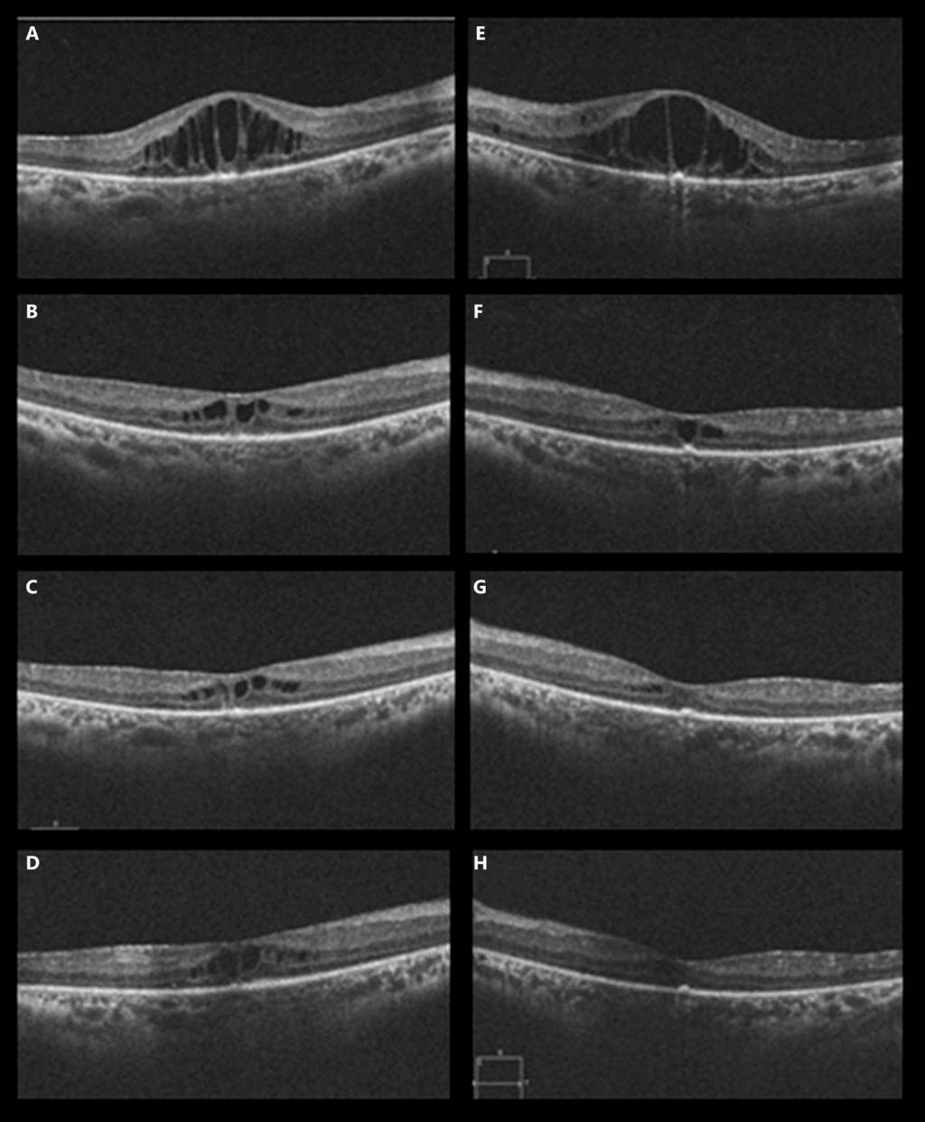 396 Fig. 3. OCT of both eyes before and after intravitreal injections of aflibercept given in Dubai.