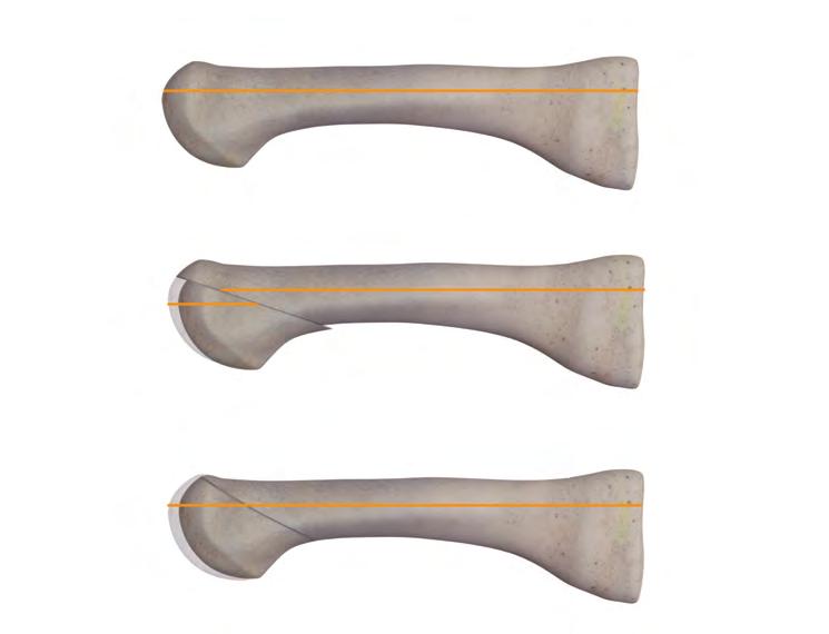 Introduction The HAT-TRICK Lesser Toe Repair System is a three-part solution to lesser toe injuries: The HAT-TRICK MTP Joint Repair System (Unilateral and Bilateral) The HAT-TRICK Osteotomy Guide for