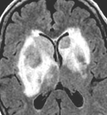 , Unenhanced CT image shows classic hyperdense masses involving deep white and gray matter., xial FLIR MR image shows isointensity of lesions to brain parenchyma and surrounding edema.