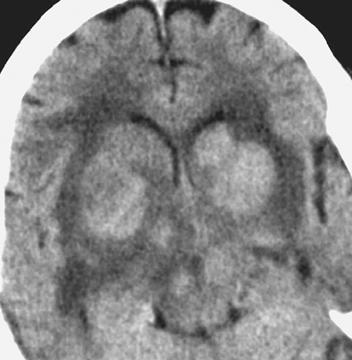 nosis is often elusive because clinical findings are often suggestive of meningoencephalitis or common conditions that cause increased intracranial pressure.