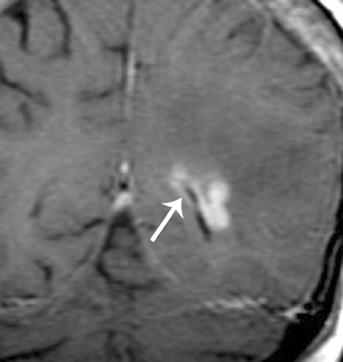 Neuroimaging is often unremarkable or may show nonspecific findings such as hydrocephalus.