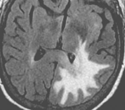 In the absence of other findings, protondensity or FLIR MRI revealing the presence of high signal intensity in the subarachnoid space may support a diagnosis of primary leptomeningeal lymphoma.