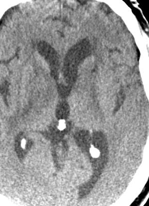 Fig. 3. 50-year-old immunocompetent man with primary CNS non-hodgkin s -cell lymphoma.