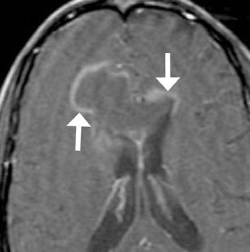 CT and MRI of Intracranial Lymphoma Downloaded from www.ajronline.org by 37.44.204.