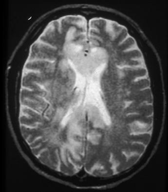 44-year-old HIV-positive woman with primary CNS non-hodgkin s -cell lymphoma.