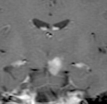 42-year-old HIV-positive man with primary CNS non- Hodgkin s -cell lymphoma.
