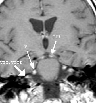 CT and MRI of Intracranial Lymphoma Fig. 8. 39-year-old man with IDS and primary CNS non-hodgkin s -cell lymphoma of leptomeninges who presented with diplopia, facial weakness, and eyelid droop.