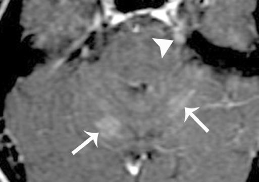 MRI findings in intravascular lymphomatosis include high-signal deep white matter lesions and infarctlike, high-signal lesions in vascular territories on T2-weighted images.
