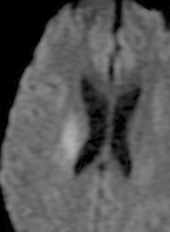 , Diffusion-weighted axial MR image shows restricted diffusion of lesion.