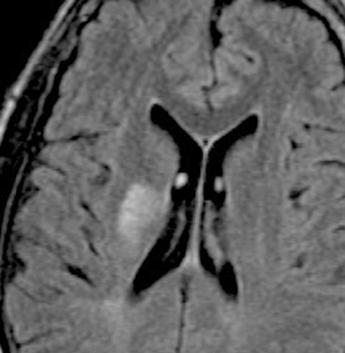 40-year-old man with primary CNS non-hodgkin s T-cell lymphoma who presented with