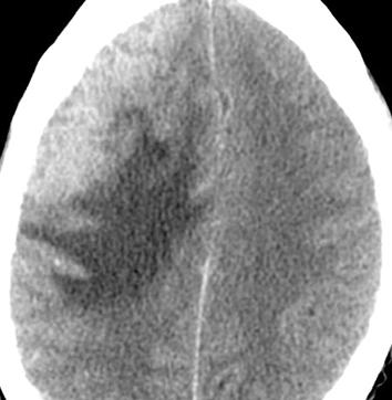 , xial contrast-enhanced T1-weighted MR image shows leptomeningeal enhancement