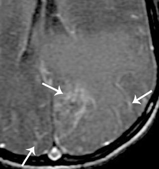 CT and MRI of Intracranial Lymphoma Downloaded from www.ajronline.org by 37.44.204.233 on 02/10/18 from IP address 37.44.204.233. Copyright RRS.