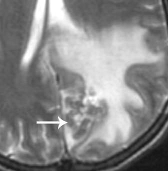 However, a high index of suspicion and the presence of features similar to those illustrated in this article can aid in the diagnosis of intracranial lymphoma. Fig. 13.