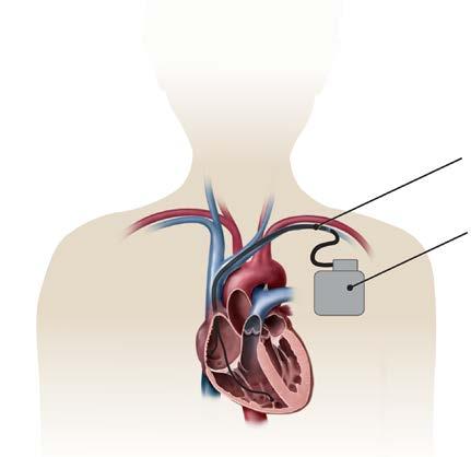Heart Arrhythmias Arrhythmias are an abnormality of the heart s electrical system. Ventricular arrhythmias are rapid heartbeats in the lower chambers of the heart.
