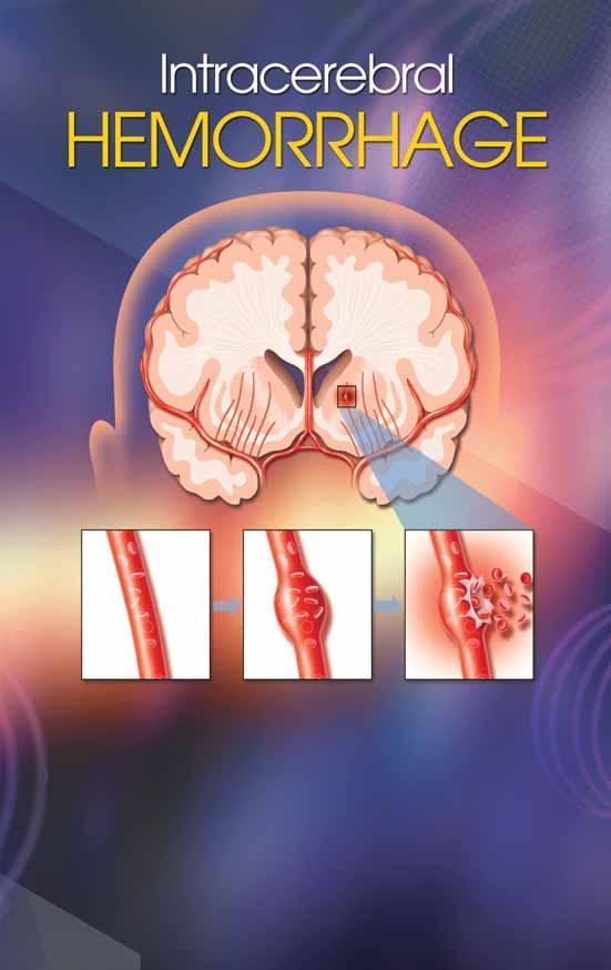 Cerebral hemorrhage Cerebral hemorrhage Middle cerebral artery Internal carotid artery Normal vessel Bulging vessel Burst vessel Strokes caused by a bursting blood vessel in the brain that spills