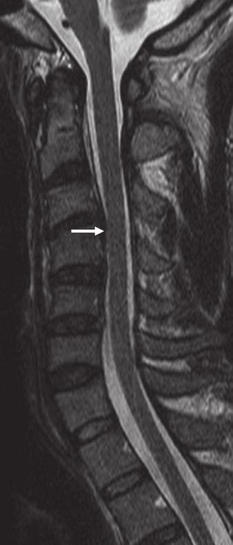 MRI Assessment of Cervical Spinal Canal Compression tient with positive neurologic manifestations in 47 patients with grade ; eight patients had negative neurologic manifestations and 14 patients had