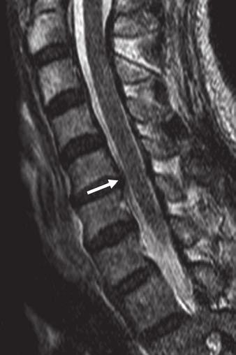 Park et al. Fig. 5 Grade 1 stenosis in 5-year-old man with neck discomfort.