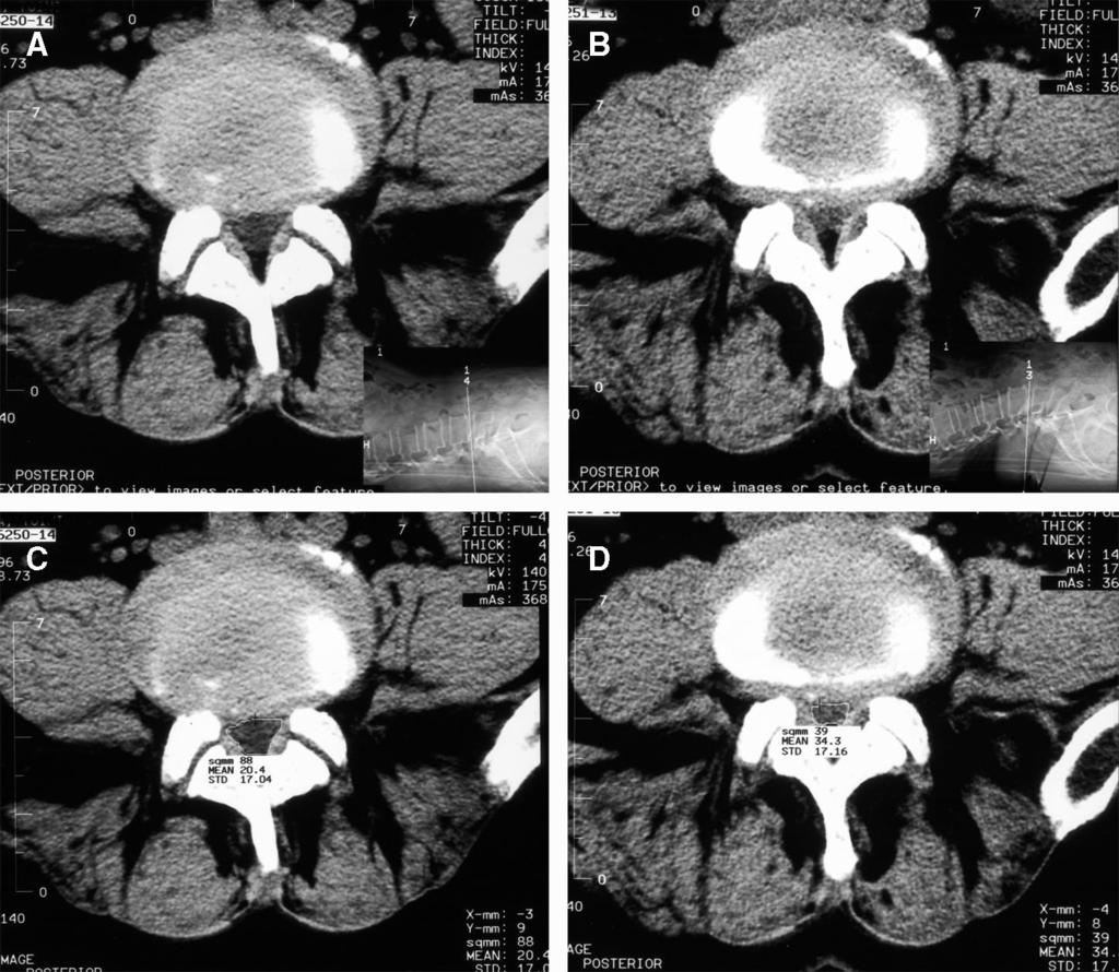 1836 Spine Volume 31 Number 16 2006 Figure 1. Example of the measurements performed. CT of L4 L5 intervertebral disc. Before (A) and after (B) compression. Measurement of A (C). Measurement of B (D).