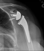 Traditional shoulder replacement is typically used for arthritic shoulders which have a functioning rotator cuff.