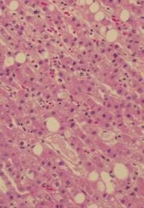 hepatocellular adenoma Case 6 *